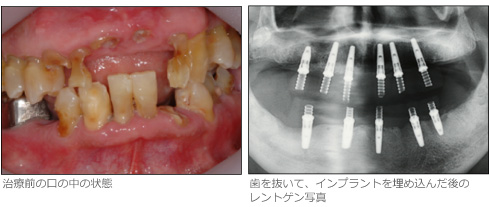 歯を抜いて、インプラントを埋め込んだ後のレ
ントゲン写真
