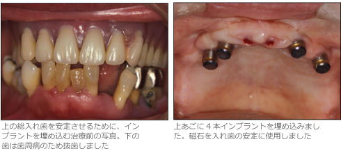 上の総入れ歯を安定させるために、インプラントを埋め込む治療前の写真。下の歯は歯周病のため抜歯しました 上あごに4本インプラントを埋め込みまし
た。磁石を入れ歯の安定に使用しました
